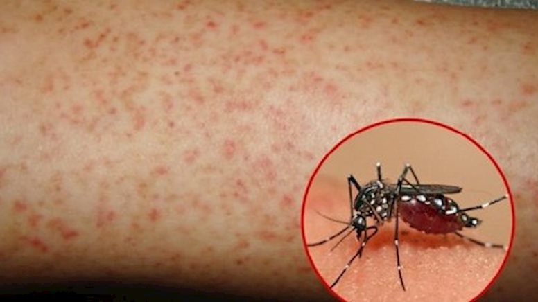 Dengue hemorrhagic fever - Hình ảnh minh họa